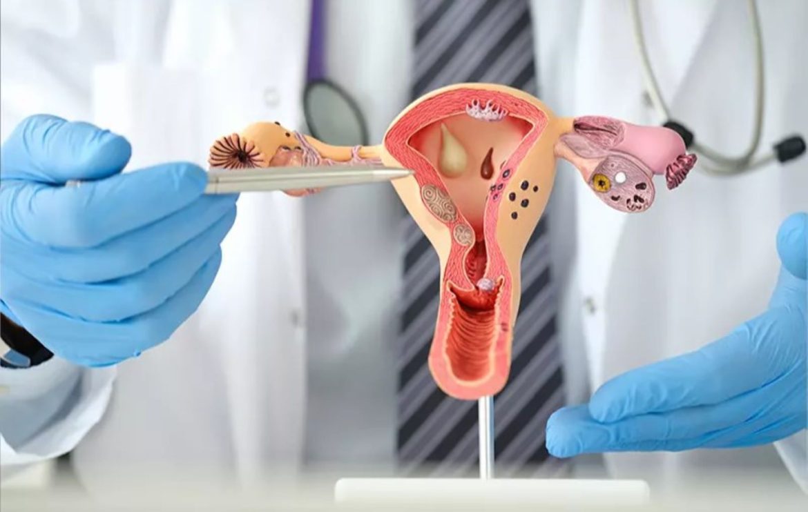 PCOS